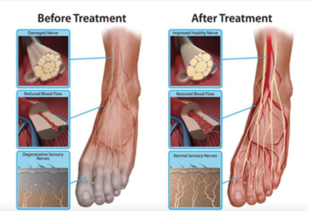 Neuropathy Revolution Benefits